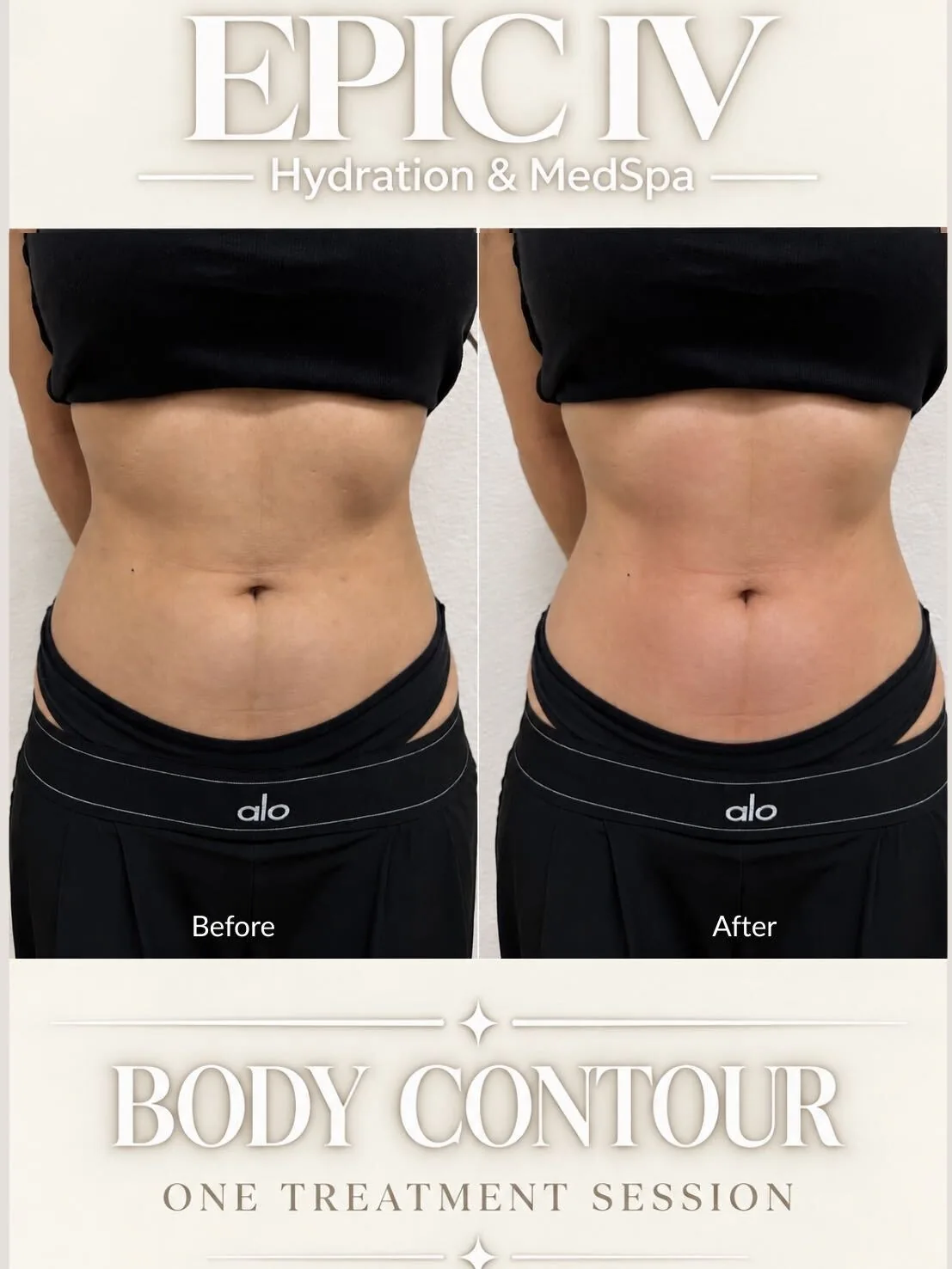 Before and after body contouring of the abdomen at Epic IV