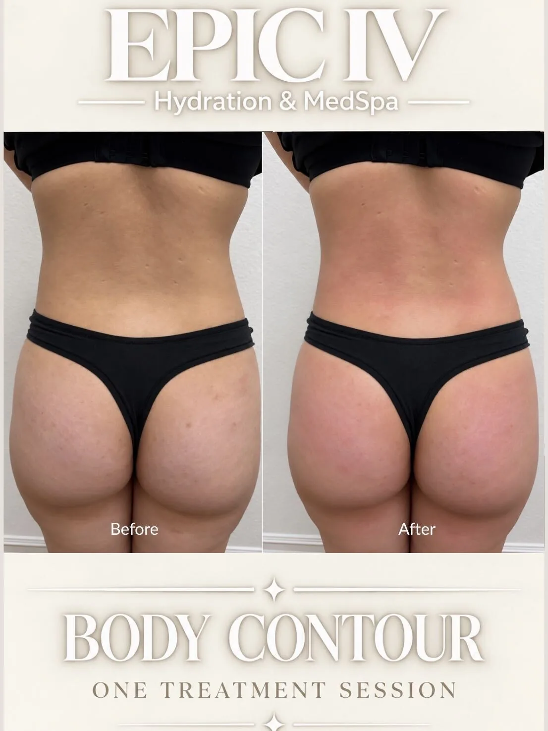 Before and after body contouring of the back and flanks at Epic IV