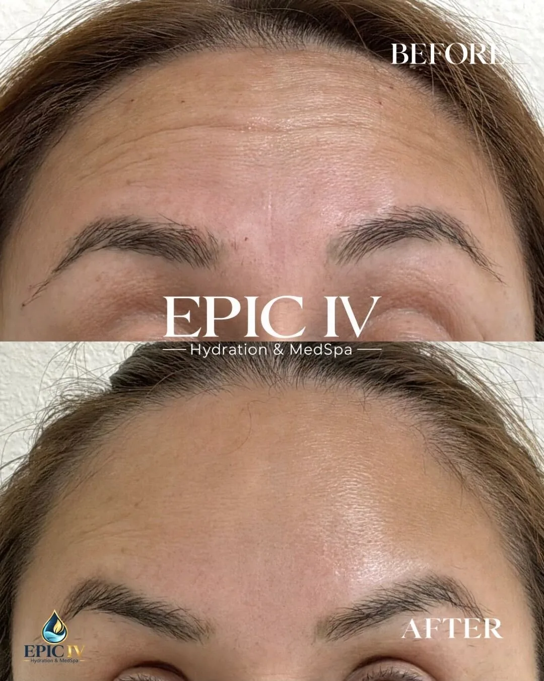 Before and after neuromodulator treatment at Epic IV, forehead lines softened