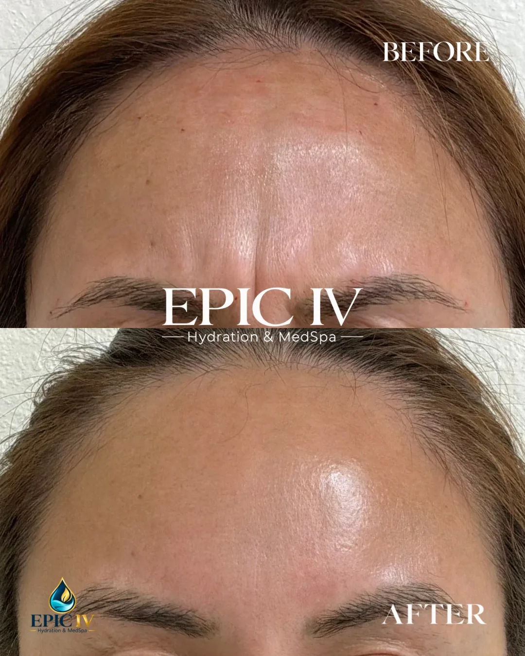 Before and after neuromodulator treatment at Epic IV, frown lines between the brows softened