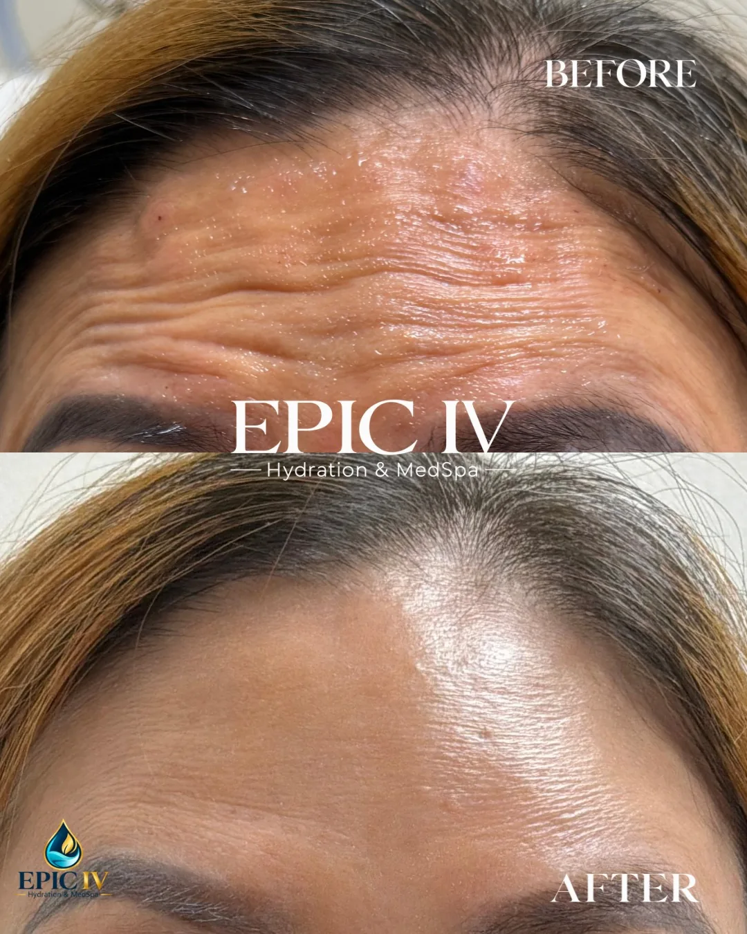 Before and after neuromodulator treatment at Epic IV, deep forehead lines softened