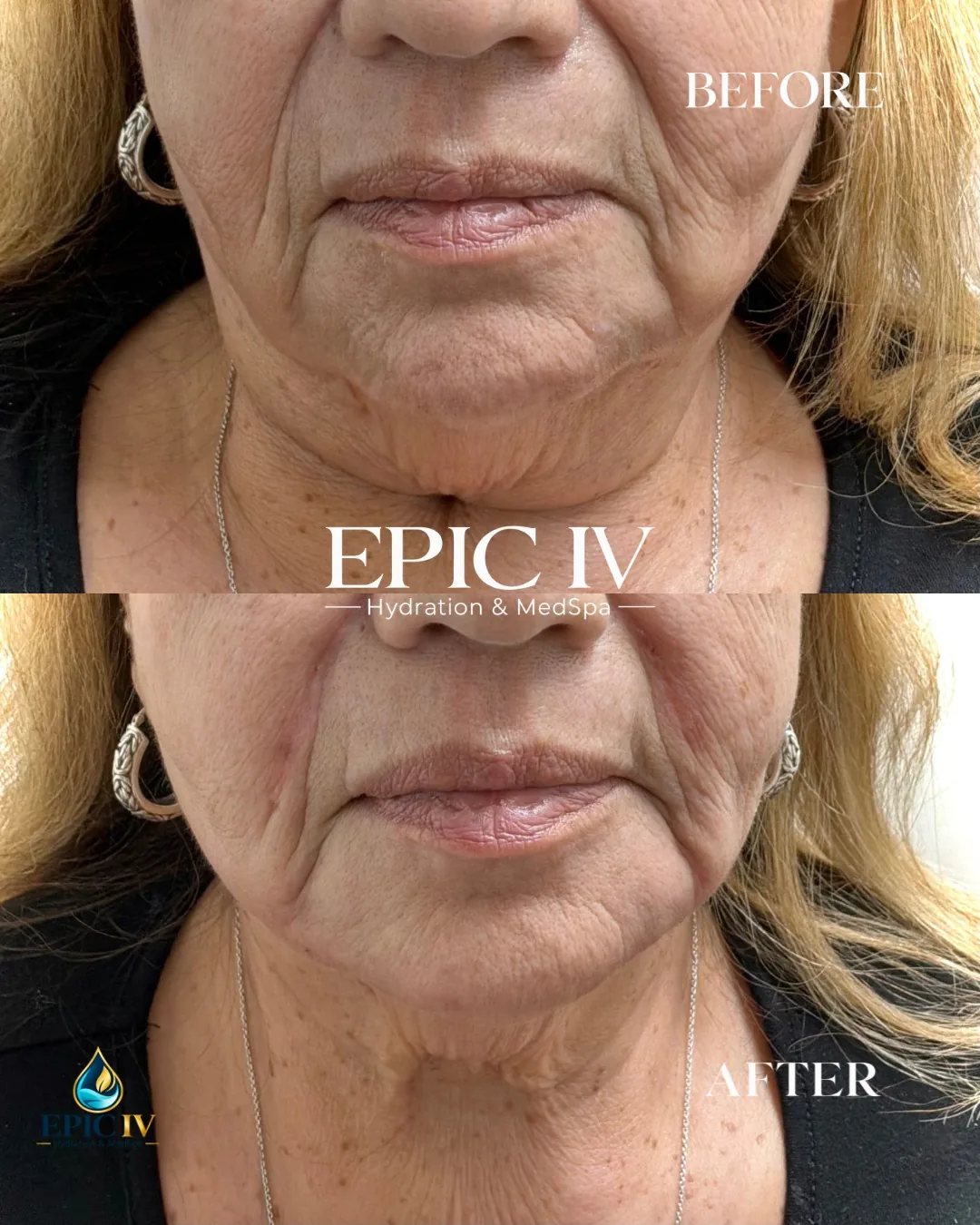 Before and after treatment of the lower face and jawline at Epic IV
