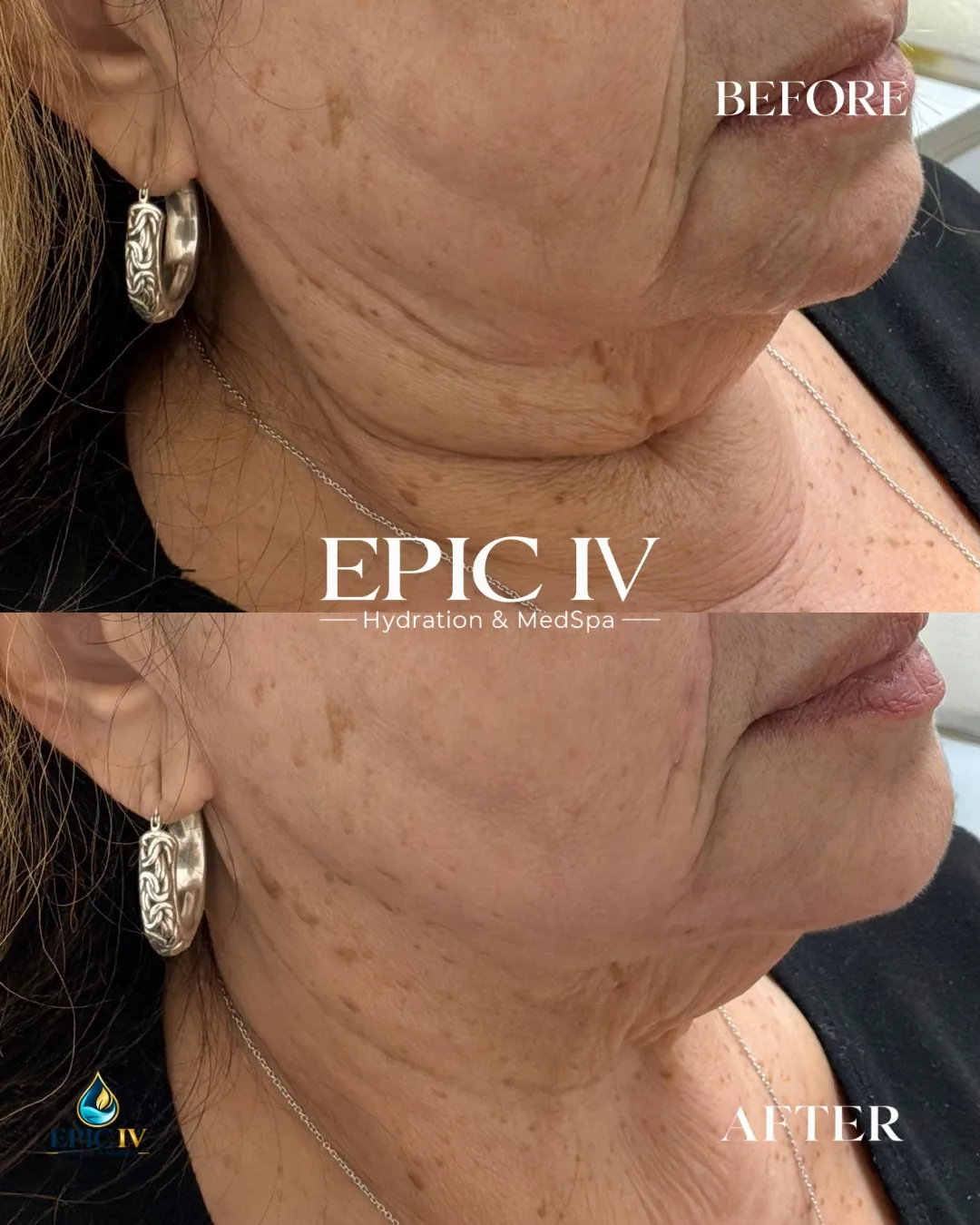Before and after treatment of the jawline and neck in profile at Epic IV